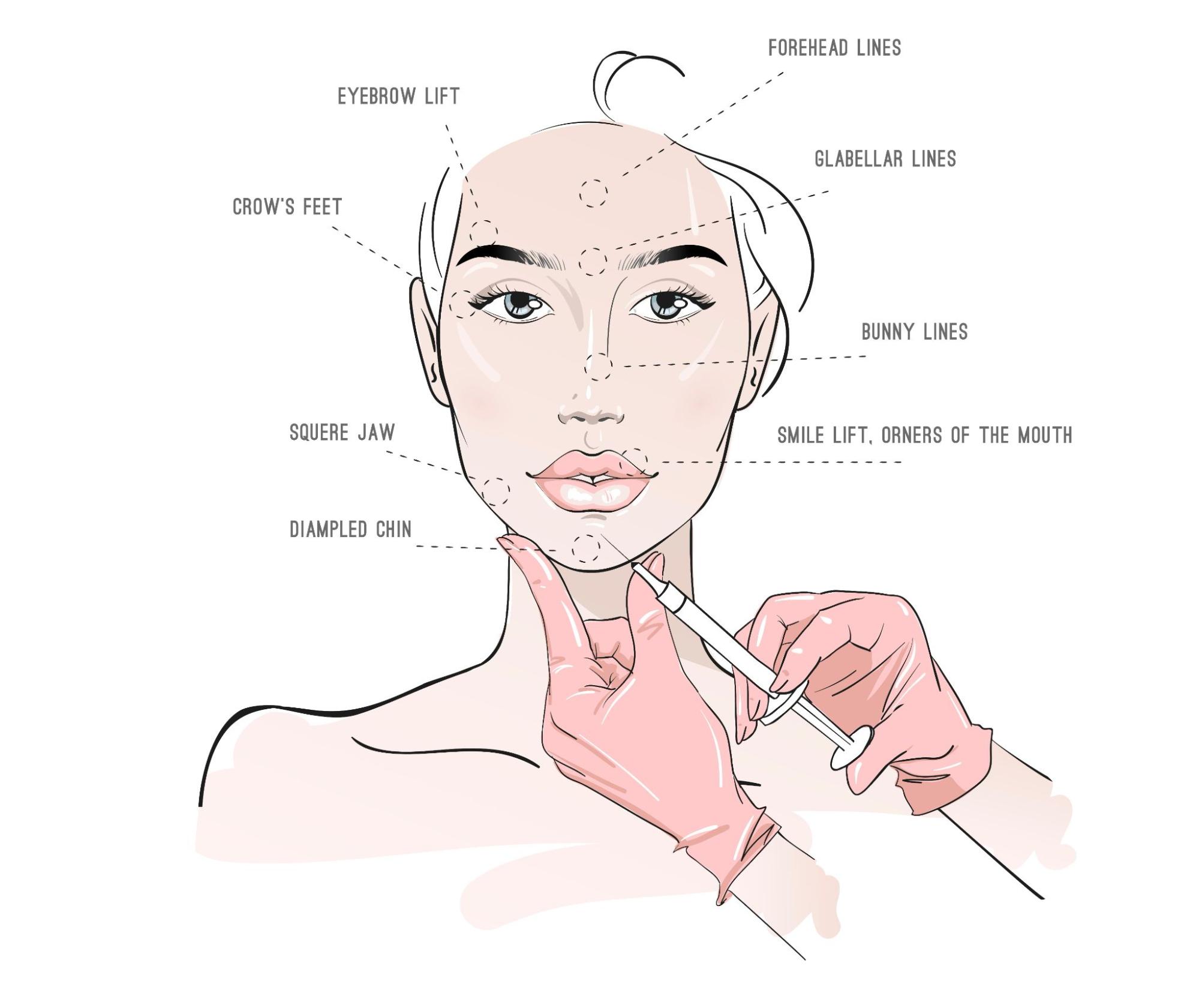 จุดฉีดฟิลเลอร์อยู่ได้นานแค่ไหน 